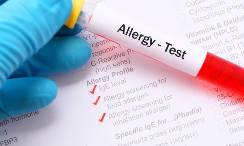 Apa saja jenis tes alergi ?