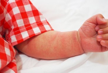 Si Kecil Alergi atau Sakit Kulit