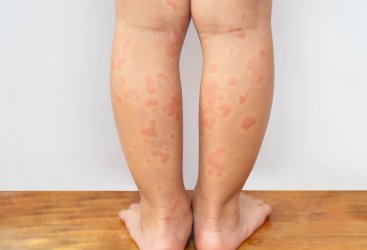 Gatal karena Alergi Cuaca Dingin