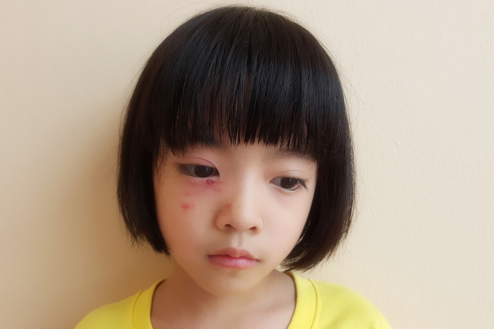 Kenali Ciri-ciri Alergi Susu Sapi pada Anak Usia 1-3 Tahun