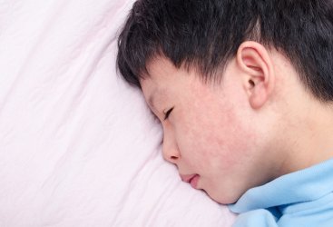 Mengatasi Biduran atau Ruam Merah pada Anak