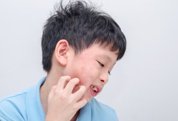 Cara Mengatasi Biduran pada Anak  Akibat Alergi Susu Sapi