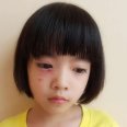 Kenali Ciri-ciri Alergi Susu Sapi  pada Anak Usia 1-3 Tahun