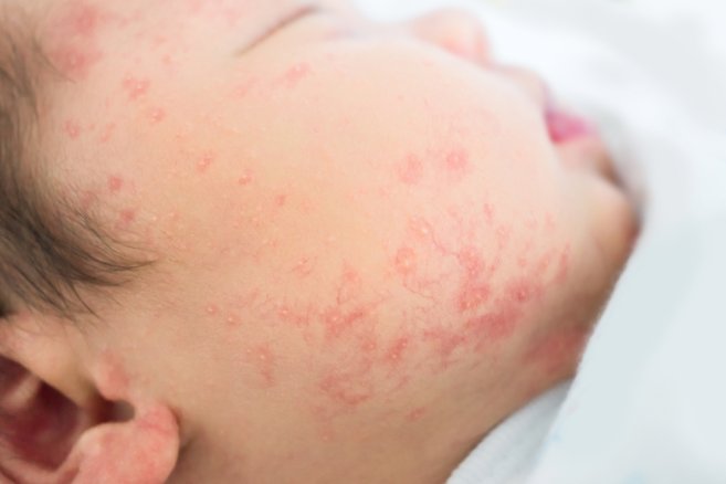 Cara Tepat Mengatasi Alergi Susu Sapi pada Anak