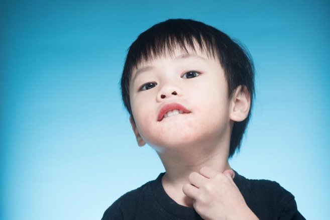 Gejala dan Cara Mengatasi Alergi Makanan pada Anak