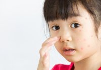 Alergi Susu Sapi, Kenali Gejala dan Cara Mengatasinya pada si Kecil