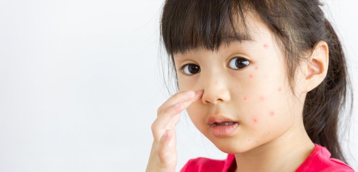 Gejala Alergi Susu Sapi pada Anak dan Cara Mengatasinya