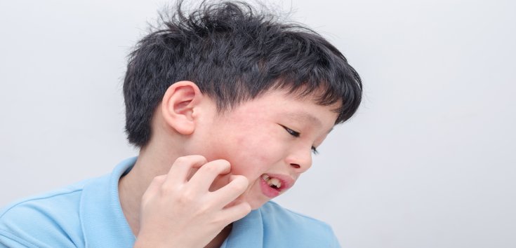 Cara Mengatasi Biduran pada Anak  Akibat Alergi Susu Sapi