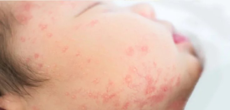 Cara Tepat Mengatasi Alergi Susu Sapi pada Anak