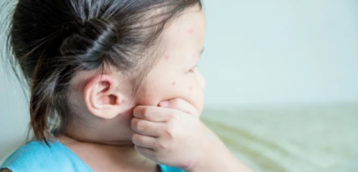 Penyebab Kaligata pada Anak dan Cara Tepat Mengatasinya