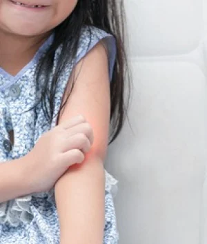 5 Cara Alami Mengobati Gatal pada Anak