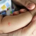 9 Cara Menghilangkan Bekas Gigitan Nyamuk pada Bayi