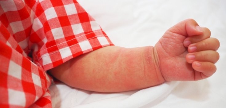 Ciri Ruam Alergi Susu Sapi, Penyebab, dan Cara Mengatasinya