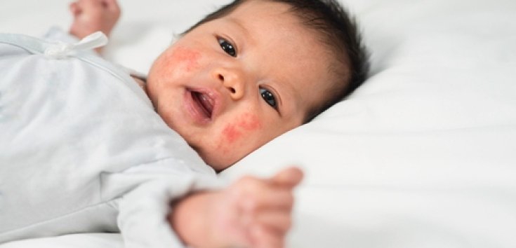 8 Cara Menghilangkan Bintik Merah di Wajah Bayi