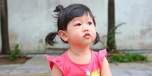 10 Ciri Anak Alergi Susu Sapi, Gejala, dan Pengobatannya