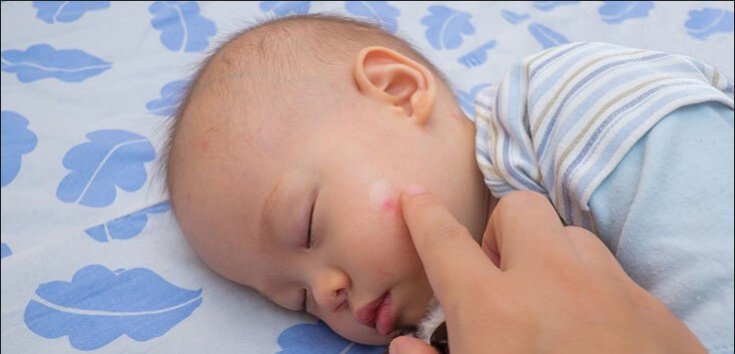 3 Jenis Gejala Alergi pada Kulit Anak yang Harus Diketahui