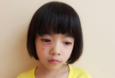 10 Ciri-ciri Alergi Susu Sapi Pada Anak 1-3 Tahun